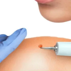 Главное фото: Новороссийск, Услуги, Красота и Здоровье, Косметология и уход за лицом: Удаление папиллом - косметологические услуги. (Все районы города Новороссийск и пригород (по договорённости)) - 05 декабря 2025 г. 02:18